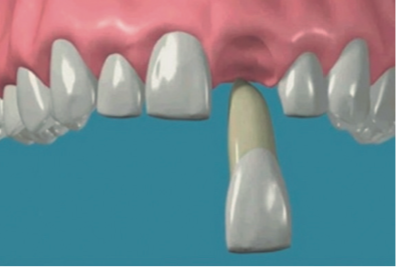 Implant dental per fractura