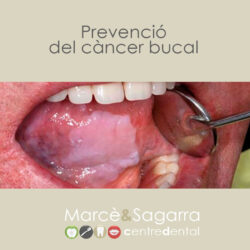 El càncer de la boca es pot prevenir