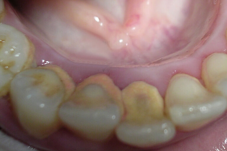 Placa-dental