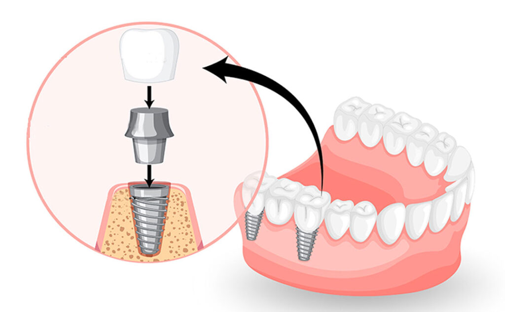 Estructura implant dental