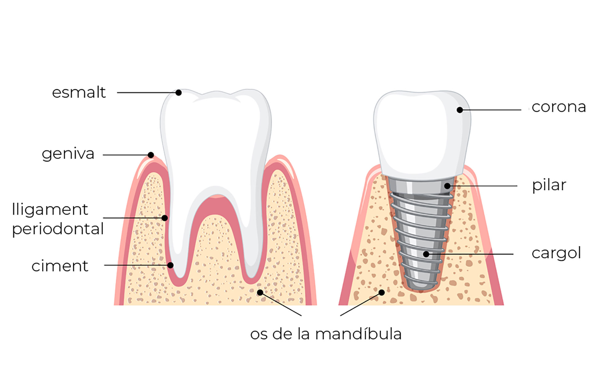 Implant dental