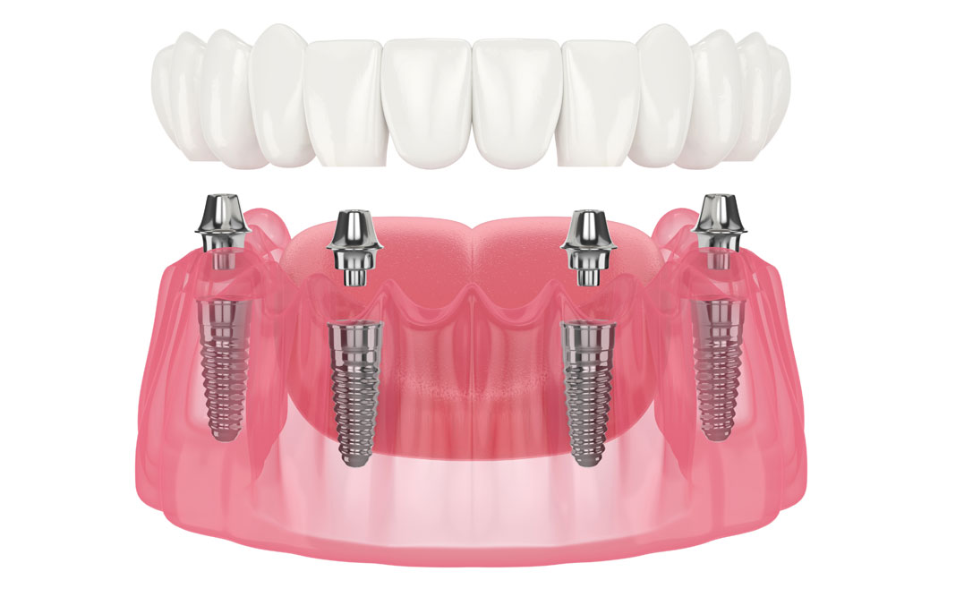 Rehabilitació arcada sencera amb implants dentals