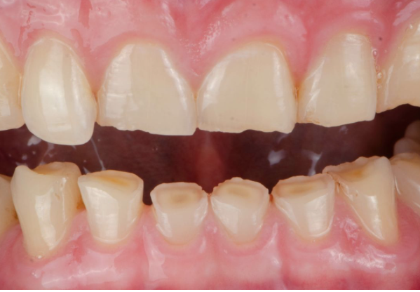 DESGAST DENTAL, CAUSES I TRACTAMENT